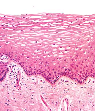 Fig. 11.1, Normal, well glycogenated, squamous mucosa of the vagina.