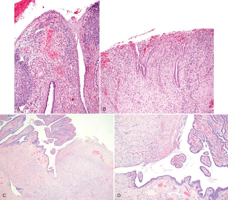 Fig. 11.11, Prolapsed fallopian tube. A, The salpingeal epithelium is in continuity with the overlying squamous mucosa. B, Salpingeal epithelium merges with an eroded mucosal surface. C, An example of prolapsed tube linked to prior cesarean section trauma in a case with an intact uterus. The tube merges with an eroded vaginal surface on the right. D, The contiguous mesothelial lining can be seen on the left .