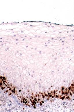 Fig. 11.2, Immunostaining of normal mucosa for Ki-67. The expression highlights nuclei just above the basal layer. This population is destined to undergo maturation.