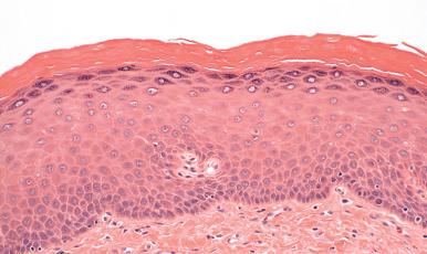 Fig. 11.4, Histologic findings in prolapse. The most prominent are mild thickening of the epithelium (acanthosis) and hyperkeratosis.