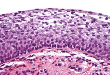 Fig. 11.5, Mucosal atrophy of the vagina. Maturation is delayed, with an increased nuclear-to-cytoplasmic ratio.