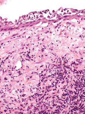 Fig. 11.6, Atrophic vaginitis. The epithelium is attenuated and coexists with a mononuclear submucosal inflammatory infiltrate.