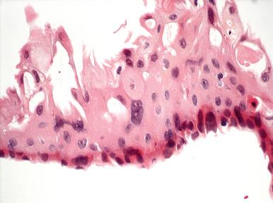 Fig. 11.7, Radiation-induced atypia is characterized by nuclear enlargement, cytoplasmic vacuoles, and abundant cytoplasm.