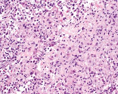 Fig. 11.8, Radiation-induced necrosis.