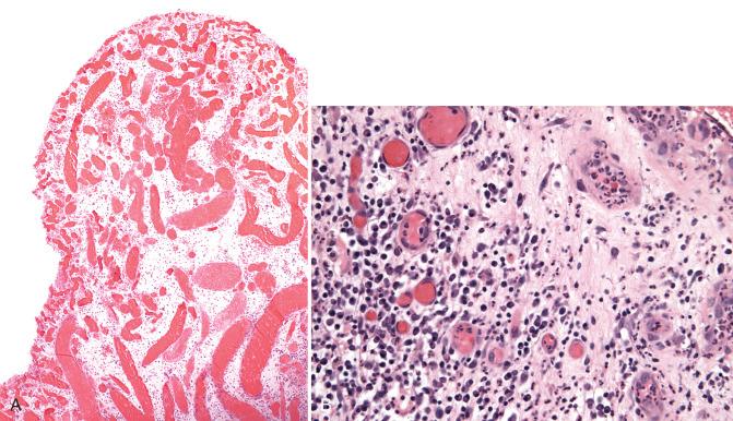 Fig. 11.9, A, Granulation tissue. In this low-power photomicrograph, the vessels are prominent, but the endothelial cells are less conspicuous. B, Note the prominent endothelial cell proliferation with a mixed inflammatory cell infiltrate.