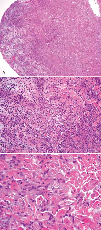 Fig. 11.10, Granulation tissue with entrapped squames. A, At low magnification, the features of granulation tissue are present. B and C, At higher power, the entrapped squamous cells might be confused with a squamous neoplasm in this context.