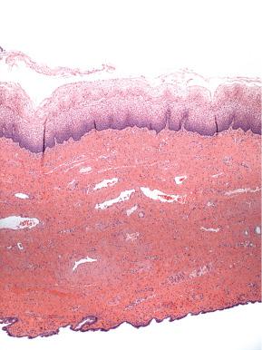 Fig. 5.4, Mucous cyst beneath the squamous mucosa.