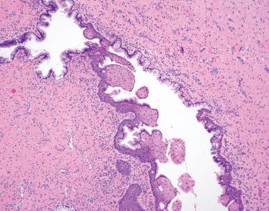 Fig. 5.5, Mucous cyst with squamous metaplasia.