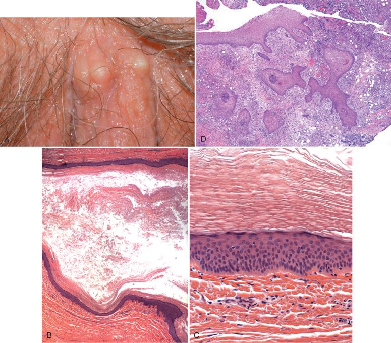 Fig. 5.6, A, Epidermal inclusion cysts (EICs) on superior vulva. B, At scanning magnification, a true EIC in the dermis with keratinaceous epithelial lining and central loose keratinous debris is noted. C, Higher power shows the squamous epithelial lining. D, Ruptured EICs with pseudoepitheliomatous hyperplasia might mimic a squamous carcinoma.