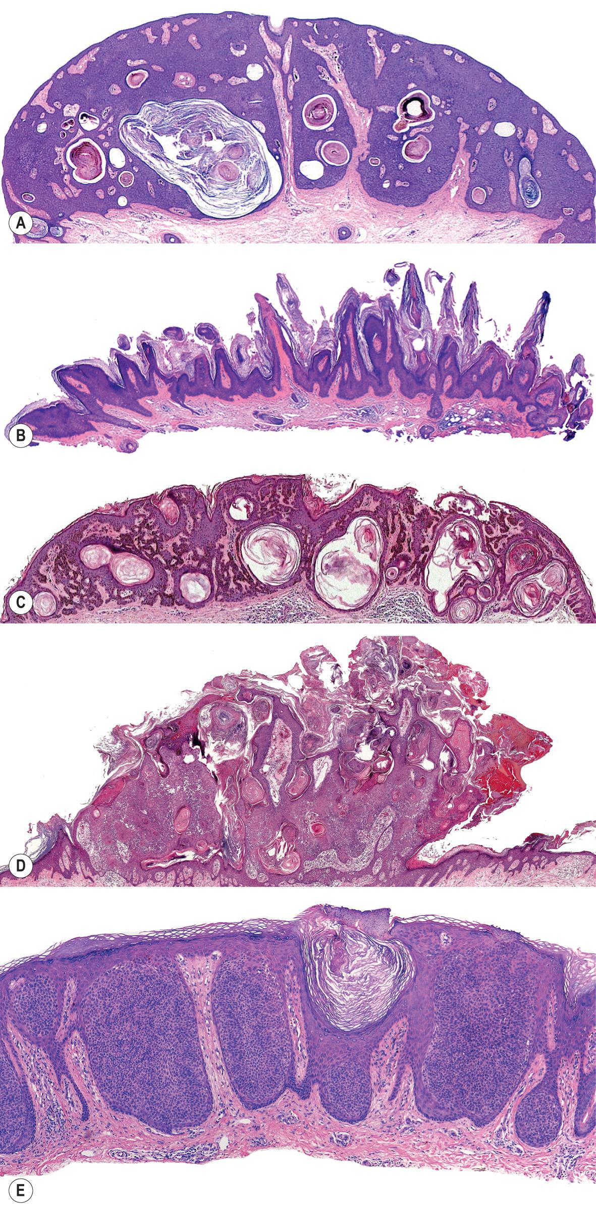 Fig. 109.4, Seborrheic keratoses (SKs) – spectrum of histologic subtypes.