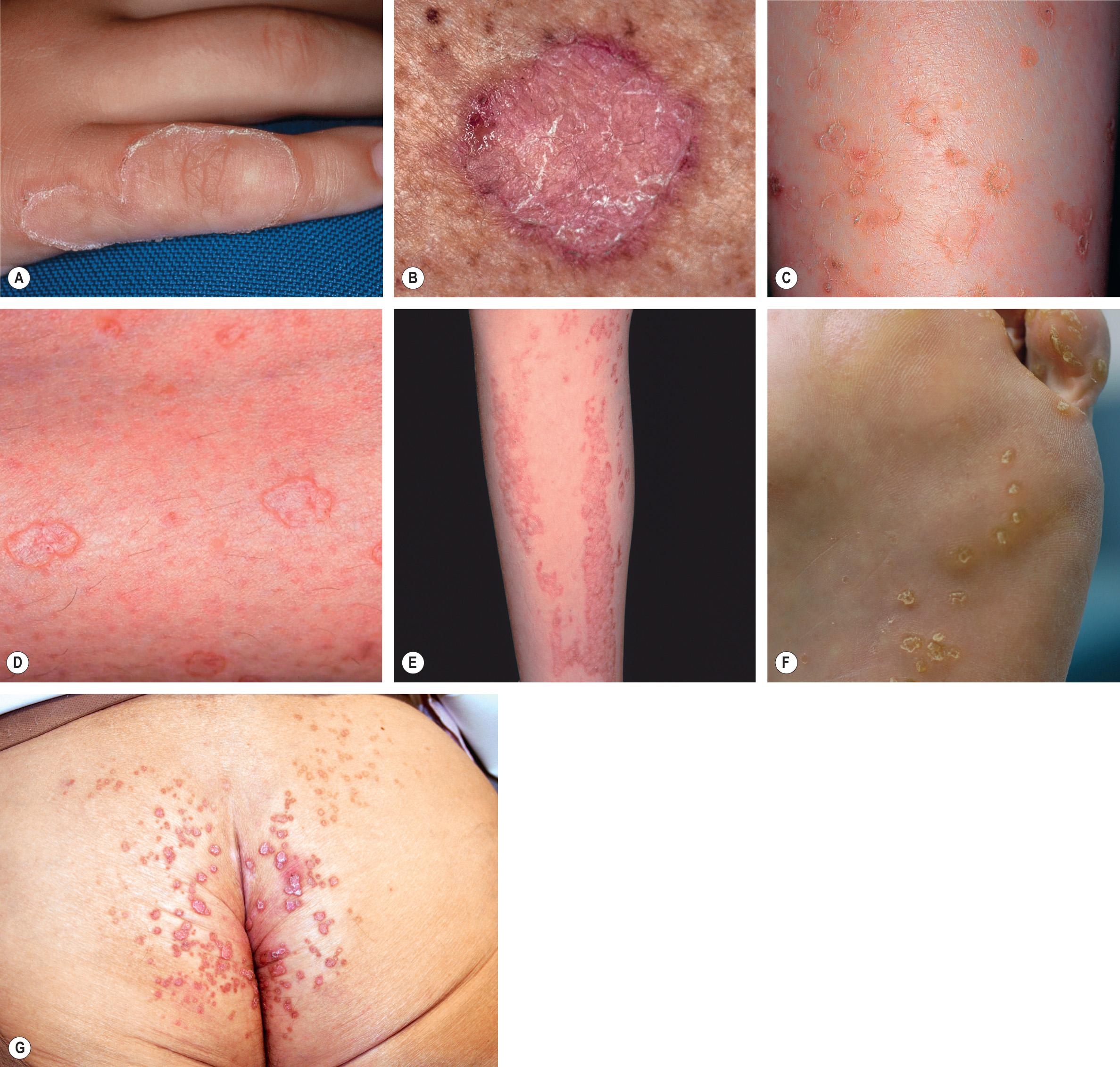 Fig. 109.8, Porokeratosis – clinical variants.