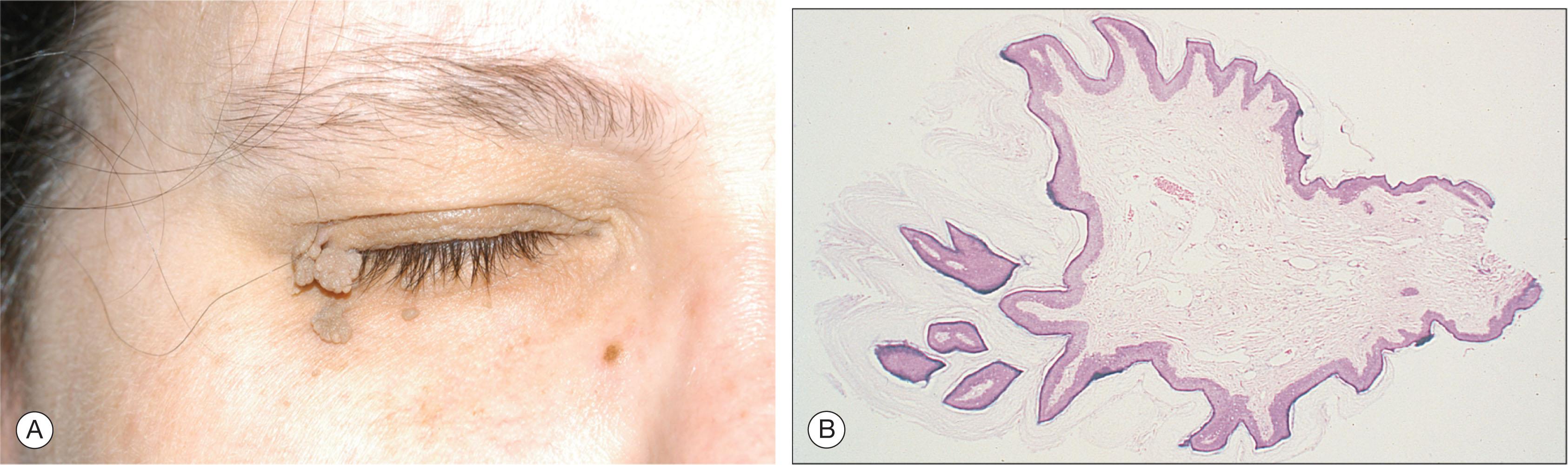 Fig. 12.7.1, Squamous Papilloma.