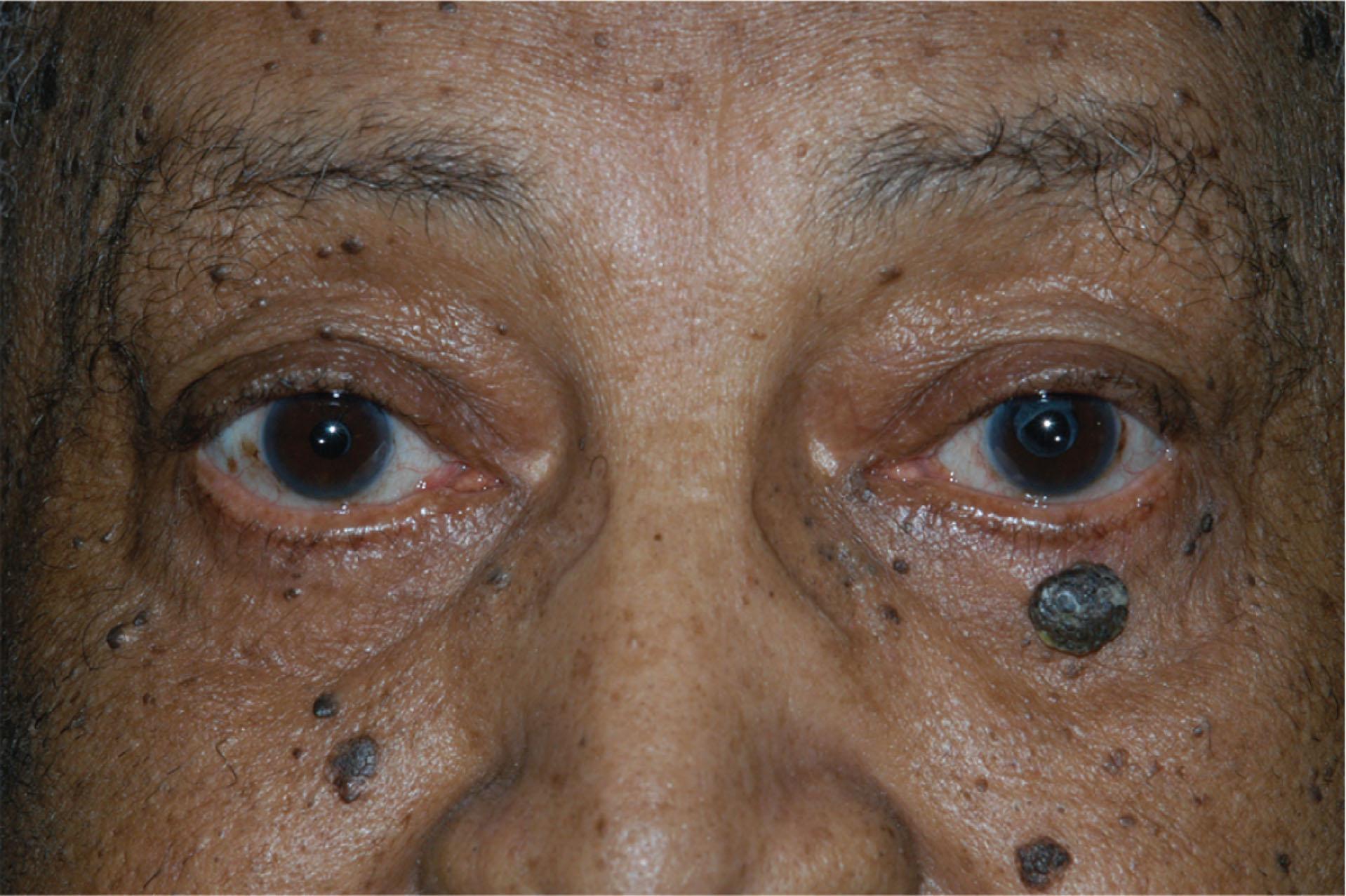 Fig. 12.7.3, Seborrheic Keratosis.