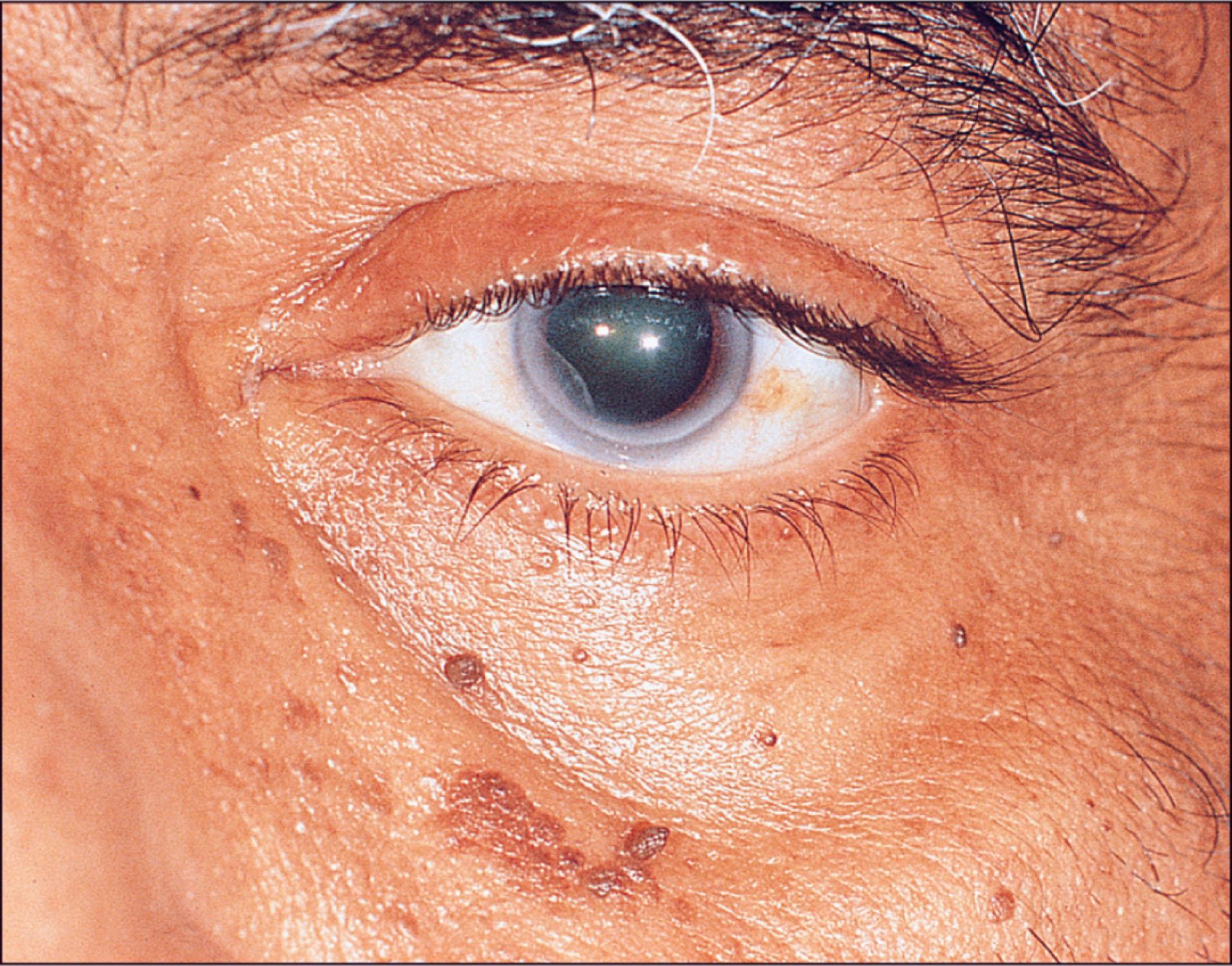 Fig. 12.7.4, Dermatosis Papulosa Nigra.