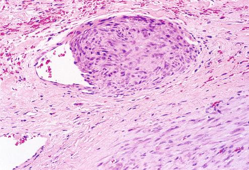 Fig. 7.14, Small satellite nodule of intravascular fasciitis.