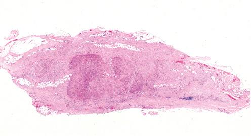 Fig. 7.18, Proliferative fasciitis involving the subcutis.