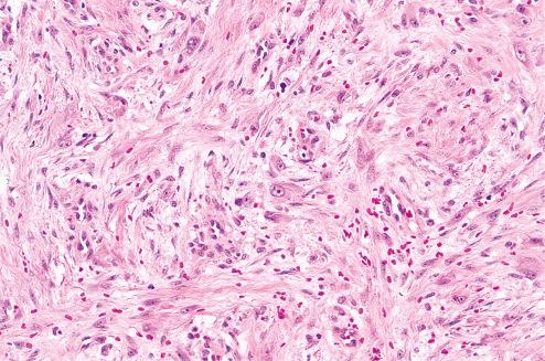 Fig. 7.19, Proliferative fasciitis composed of a mixture of fibroblasts and giant cells with abundant basophilic cytoplasm bearing some resemblance to ganglion cells.