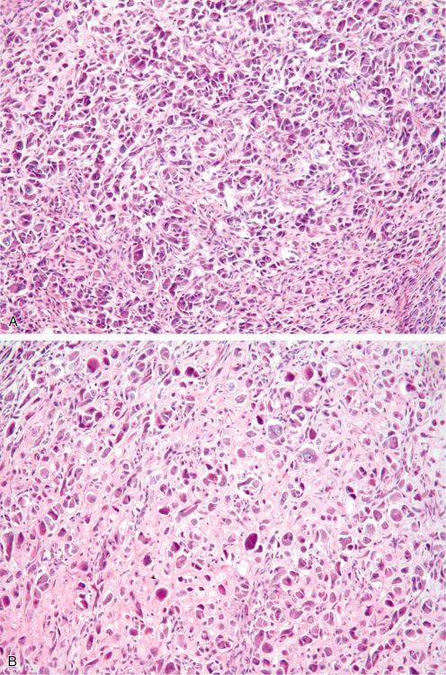 Fig. 7.20, Proliferative fasciitis showing variation in cellularity.