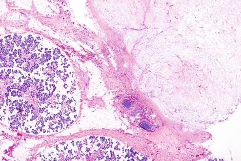 Fig. 7.3, Nodular fasciitis involving the parotid gland. Note the circumscription and profuse myxoid change in the central portion of the lesion.