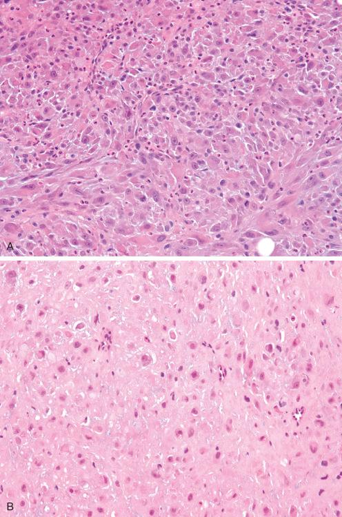 Fig. 7.22, Cellular proliferative fasciitis as often seen in children showing back-to-back cells and neutrophilic infiltrate with scattered apoptotic bodies ( A ) and extreme hyalinization with regression ( B ).