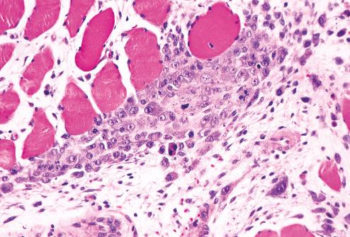 Fig. 7.25, Proliferative myositis. Ganglion-like giant cells are seen immediately adjacent to and infiltrating skeletal muscle fibers.