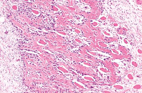 Fig. 7.27, Unusual case of proliferative myositis with extensive metaplastic bone formation.