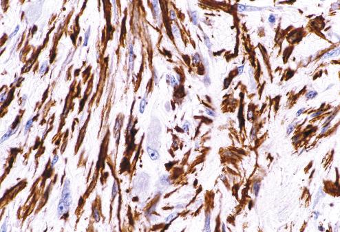 Fig. 7.28, Proliferative myositis stained for smooth muscle actin. Most spindle cells stain for this antigen, but the ganglion-like cells, in this case, are negative.