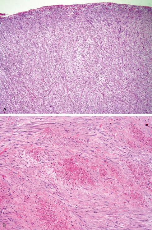 Fig. 7.29, Pseudosarcomatous myofibroblastic proliferation of bladder showing ulcerated mucosal surface ( A ) and deep extension into muscle ( B ).