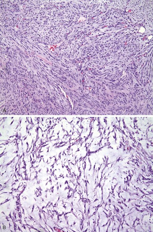 Fig. 7.30, Cellular ( A ) and myxoid ( B ) areas in pseudosarcomatous myofibroblastic proliferation.