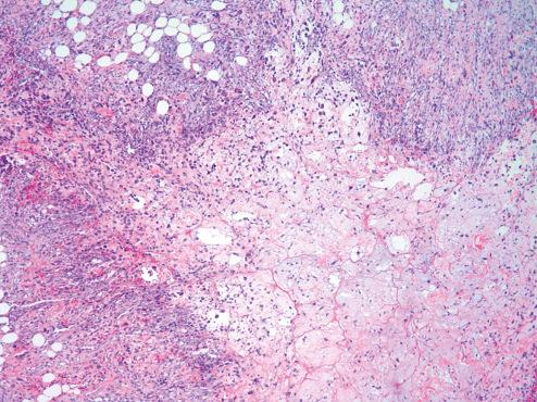 Fig. 7.32, Zonal Pattern in Ischemic Fasciitis.