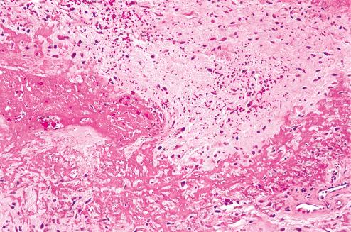 Fig. 7.33, Interface between a liquefactive zone with fibrinous material and a reactive zone with atypical-appearing fibroblasts.