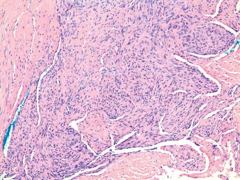 Fig. 7.35, Fibroma of tendon sheath showing nodular configuration and cleftlike spaces peripherally.