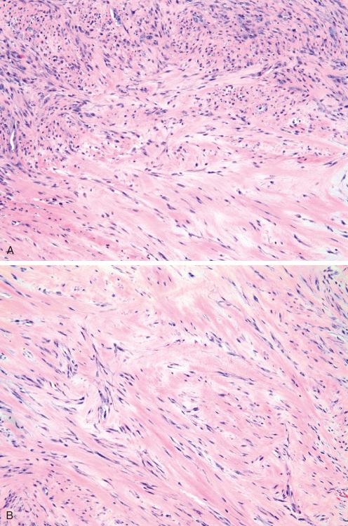 Fig. 7.36, Fibroma of tendon sheath showing transition between cellular and hyalinizing areas ( A ) and hyalinized area ( B ).