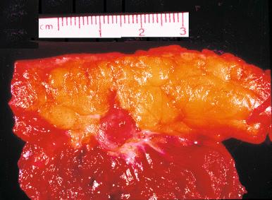 Fig. 7.5, Gross appearance of the subcutaneous form of nodular fasciitis. The lesion is small and well circumscribed; it is superficially attached to the fascia.