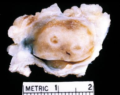 Fig. 7.6, Nodular fasciitis with central cystlike spaces, with accumulation of myxoid ground substance.