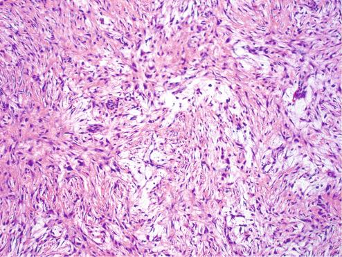 Fig. 7.7, Area of myxoid degeneration in nodular fasciitis.