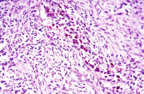 Fig. 7.9, Nodular fasciitis with focal hemosiderin deposition, a feature rarely seen in this lesion.