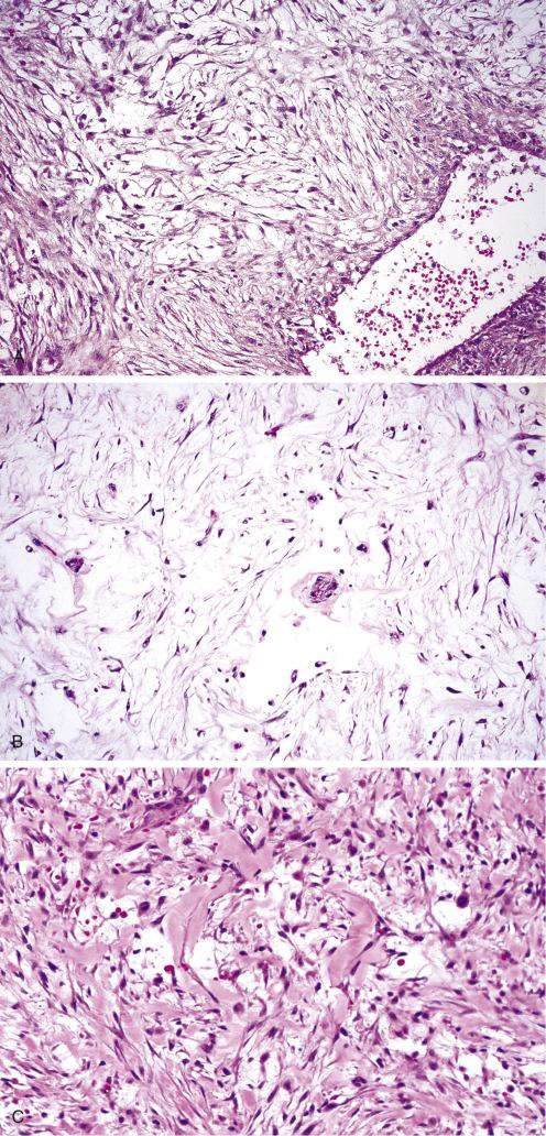 Fig. 7.10, Nodular Fasciitis.