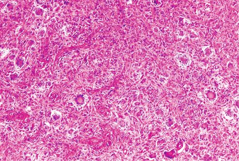 Fig. 10.11, Fibrous histiocytoma with numerous Touton giant cells.