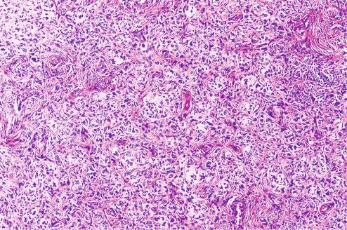 Fig. 10.12, Fibrous histiocytoma with lipidized appearance and some nuclear atypia.