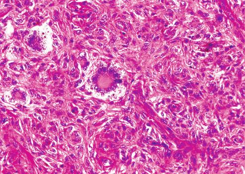 Fig. 10.14, Touton giant cells containing lipid and hemosiderin.