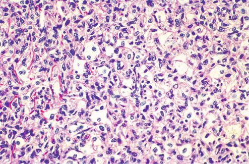 Fig. 10.15, Xanthoma cells within fibrous histiocytoma.