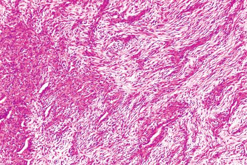 Fig. 10.17, Fibrous histiocytoma of soft tissue with myxoid areas.