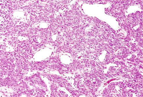 Fig. 10.18, Pericytoma-like area within fibrous histiocytoma of soft tissue.