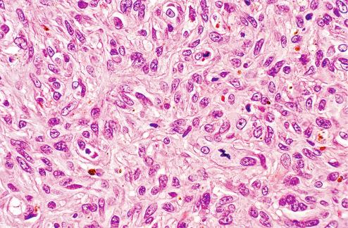 Fig. 10.19, Plump spindle cells with benign fibrous histiocytoma displaying occasional mitotic figure.