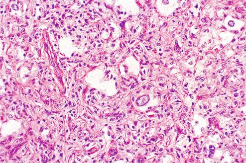 Fig. 10.20, Pleomorphic (monster) cell within otherwise benign fibrous histiocytoma of the skin.