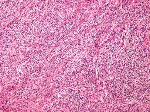 Fig. 10.21, Cellular fibrous histiocytoma illustrating monomorphic spindle cells arranged in short and long fascicles.