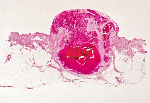 Fig. 10.23, Aneurysmal fibrous histiocytoma.