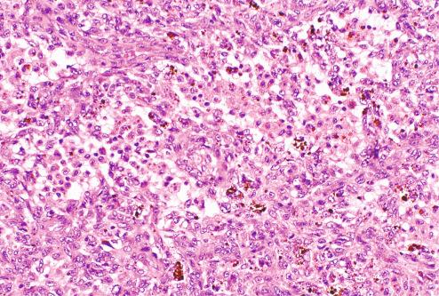 Fig. 10.25, Hemosiderin deposits in aneurysmal fibrous histiocytoma.