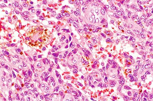 Fig. 10.26, Hemosiderin deposits and cystic hemorrhage in aneurysmal fibrous histiocytoma.